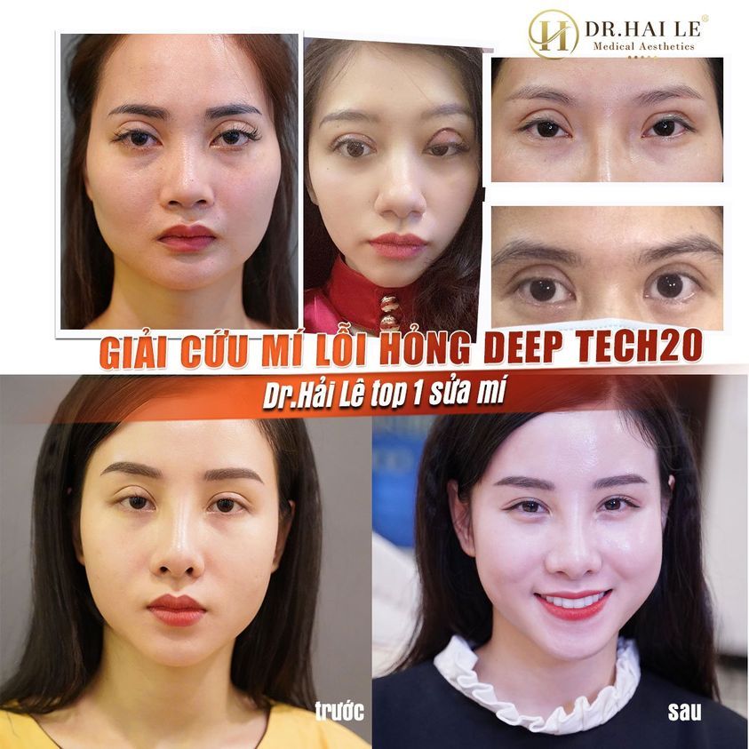 GIẢI CỨU MÍ LỖI, HỎNG DEEP TECH20 - DR.HẢI LÊ TOP 1 SỬA MÍ
