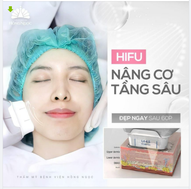 HIFU: NÂNG CƠ TẦNG SÂU - ĐẸP NGAY SAU 60P