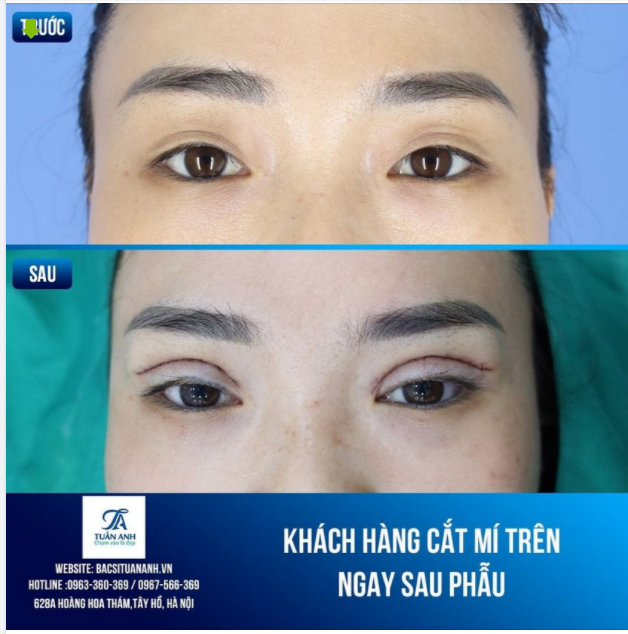 Hình ảnh trước và sau cắt mí của thẩm mỹ tuấn Anh
