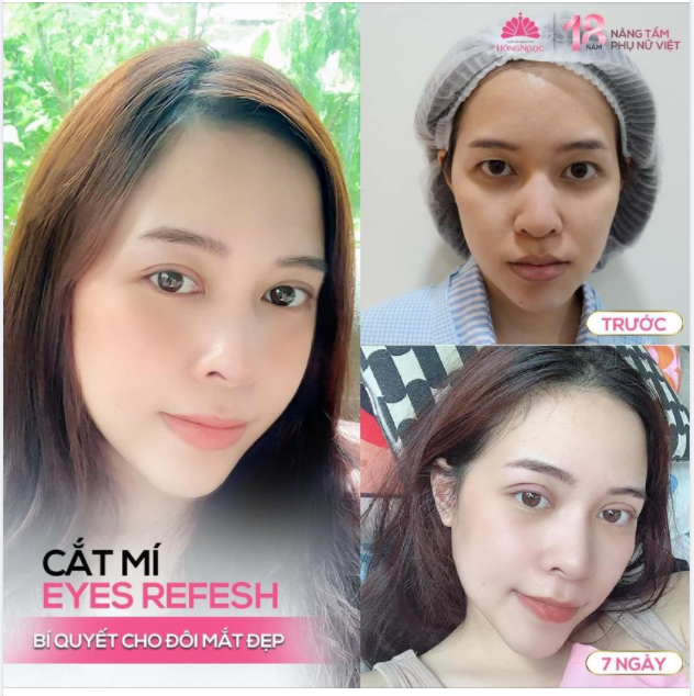 ''HÔ BIẾN'' MẮT 1 MÍ - SỞ HỮU NGAY MẮT 2 MÍ TRÒN ĐỀU VỚI CẮT MÍ EYES REFESH