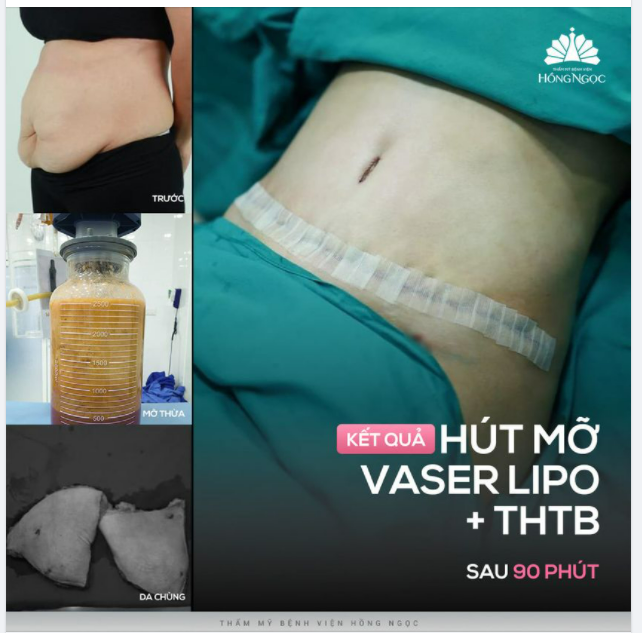 ''HỒI DÁNG'' THẦN TỐC LẤY LẠI EO THON CHO MẸ 2 CON CHỈ SAU 90P THỰC HIỆN COMBO HÚT MỠ VASER LIPO + THTB