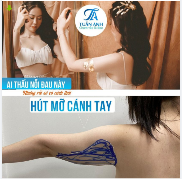 HÚT MỠ BẮP TAY nhờ Công nghệ Cơ Học LIPO MATIC