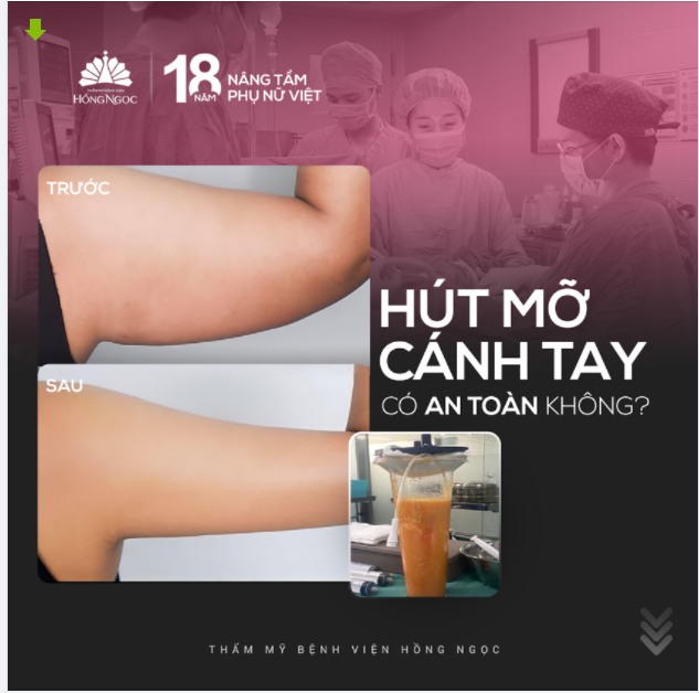 HÚT MỠ CÁNH TAY CÓ AN TOÀN KHÔNG