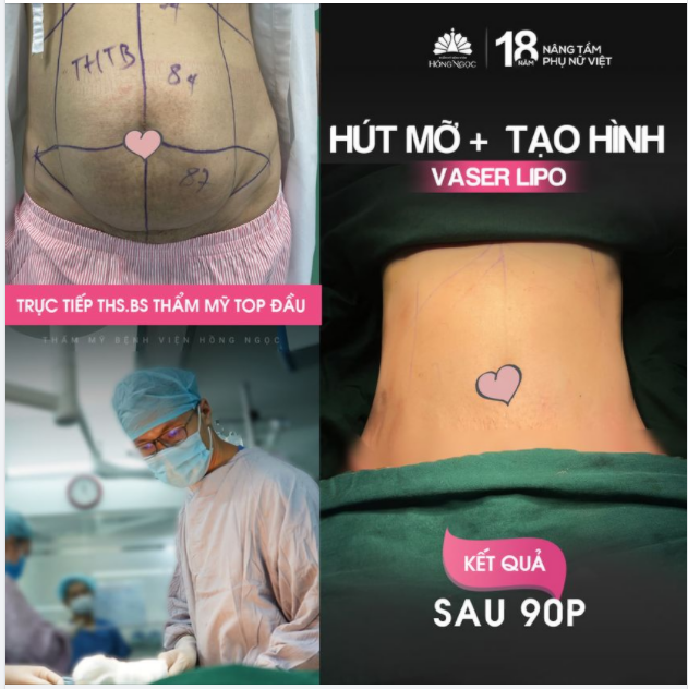 HÚT MỠ KẾT HỢP TẠO HÌNH THÀNH BỤNG GIẢI PHÁP CHO CHỊ EM CÓ VÒNG 2 QUÁ KHỔ