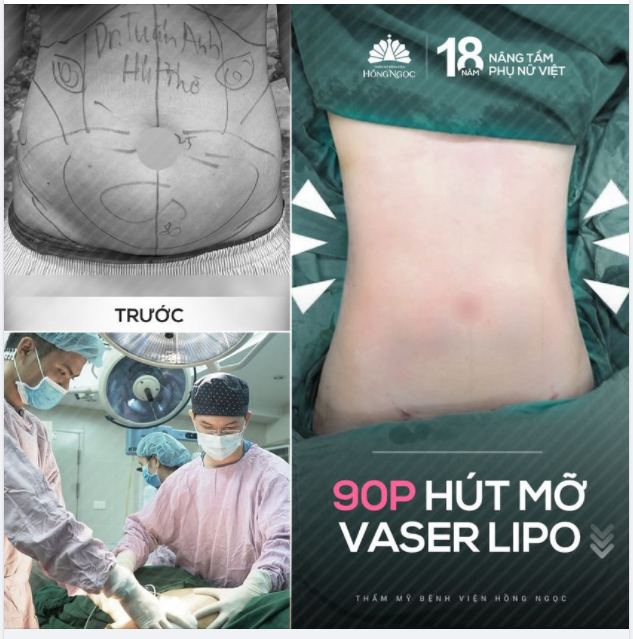 HÚT MỠ VASER LIPO - 90P TRẢ LẠI VÒNG EO CON KIẾN CHO BÀ MẸ 2 CON HOÀNG Anh