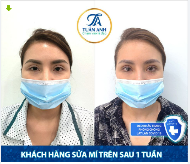 KẾT QUẢ CA GIẢI CỨU MÍ TRÊN BỊ CẮT HỎNG SAU 1 TUẦN !!!