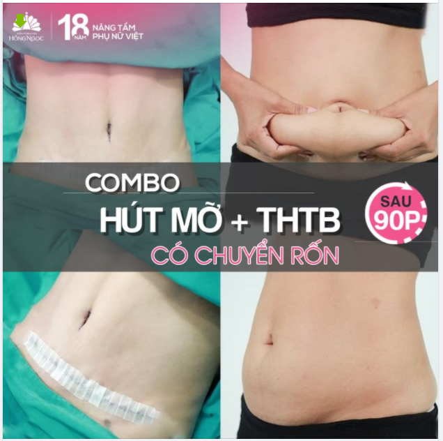 KẾT QUẢ HÚT MỠ + TẠO HÌNH THÀNH BỤNG KẾT HỢP CHUYỂN RỐN SAU 90 ĐẸP HOÀN HẢO