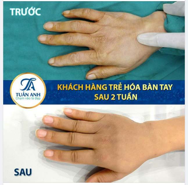 KẾT QUẢ SAU 2 TUẦN TRẺ HÓA MU BÀN TAY BẰNG MỠ TỰ THÂN:
