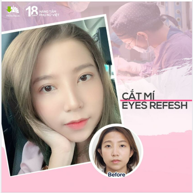 KHẮC PHỤC MẮT 1 MÍ, MÍ LÓT, 2 MÍ KHÔNG ĐỀU VỚI CẮT MÍ EYES REFESH