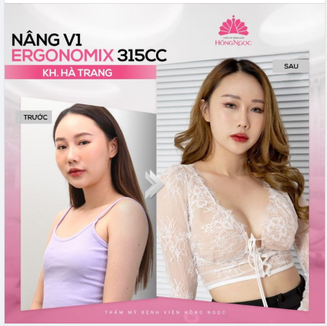 KHOE VỚI CẢ NHÀ ''CỰC PHẨM'' V1 CĂNG MỀM, TỰ NHIÊN CỦA KHÁCH HÀNG HÀ TRANG SAU 2 THÁNG NÂNG CẤP