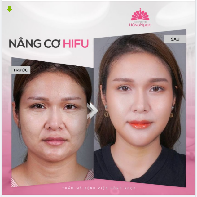 KHÔNG CÓ NGƯỜI PHỤ NỮ XẤU - CHỈ CÓ PHỤ NỮ KHÔNG BIẾT ĐẾN NÂNG CƠ HIFU