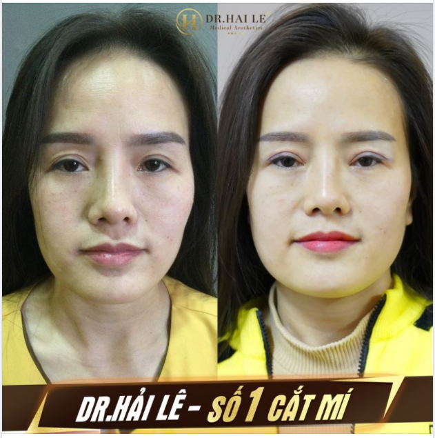 Lại 1 "cực phẩm" cắt mí tại Dr.Hải Lê hôm nay đây ạ Nhìn đôi mắt ấy cứ gọi là "khác nhau một trời một vực"