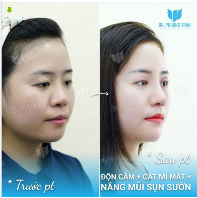 LÀM 1 LƯỢT 3 DỊCH VỤ: CẮT MÍ + NÂNG MŨI + ĐỘN CẰM