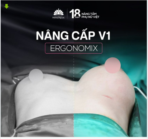 LÊN SÓNG CA NÂNG CẤP V1 ERGONOMIX 315CC THỨ 3 TRONG NGÀY TẠI THẨM MỸ BỆNH VIỆN HỒNG NGỌC