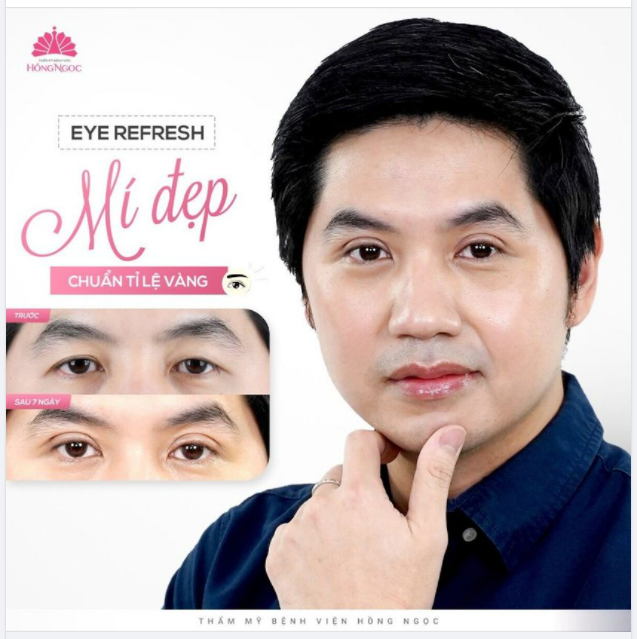 LỊCH LÃM VÀ NAM TÍNH VỚI CẮT MÍ EYES REFESH SAU 15 NGÀY