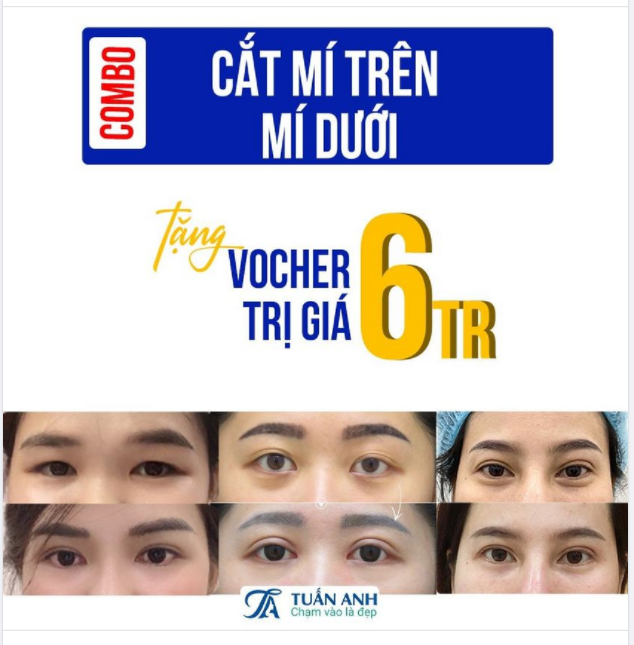 LOẠI BỎ DA CHÙNG - TẠO DIỆN MẠO TRẺ TRUNG VỚI COMBO CẮT MÍ TRÊN MÍ DƯỚI CHỈ VỚI 14TRIỆU TRONG THÁNG 10