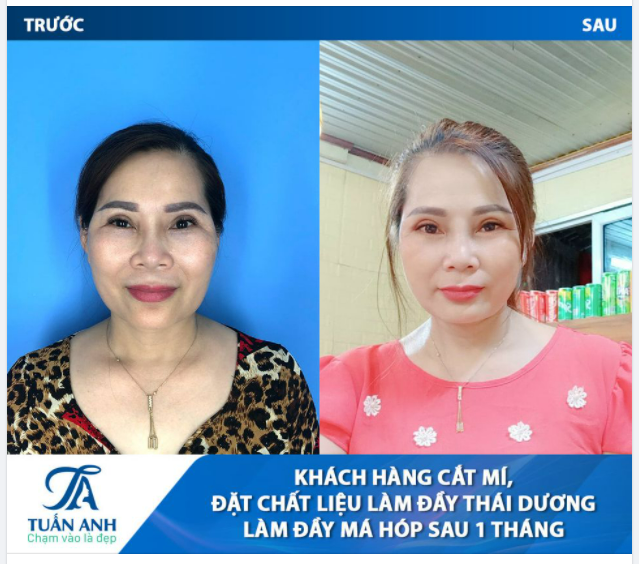 Loại bỏ dấu hiệu tuổi tác trên gương mặt khách hàng, lấy lại tuổi xuân giúp chị có diện mạo trẻ trung và hạnh phúc trong cuộc sống với combo 3 dịch vụ được thực hiện trực tiếp bởi Bác sĩ Tuấn Anh: