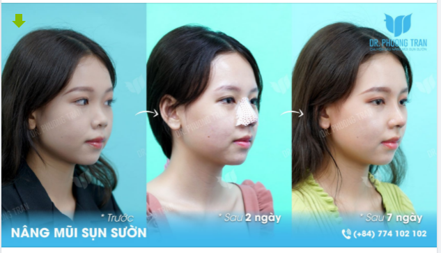 LỜI KHUYÊN DÀNH CHO CÁC BẠN MŨI NGẮN