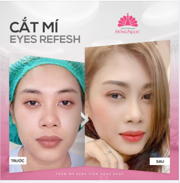 MẮT NHIỀU NẾP MÍ PHẢI LÀM SAO?