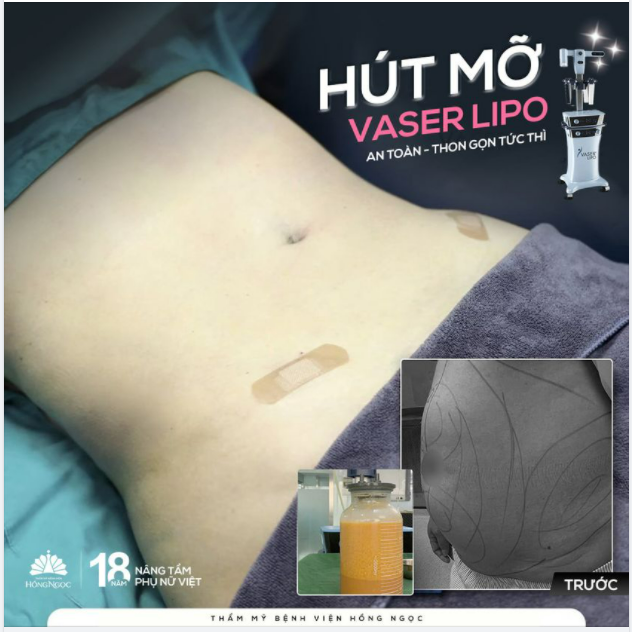 MẸ BỈM SỮA LẤY LẠI VÒNG EO ''MƠ ƯỚC'' NHỜ CÔNG NGHỆ HÚT MỠ VASER LIPO
