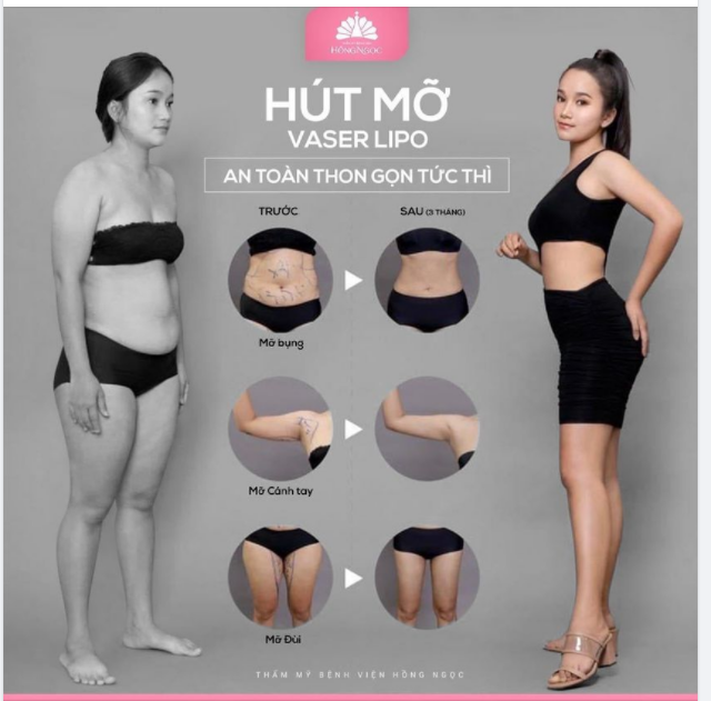 'MẸ SỀ'' VỀ DÁNG ''VẠN NGƯỜI MÊ'' SAU KHI TRẢI NGHIỆM CÔNG NGHỆ HÚT MỠ VASER LIPO