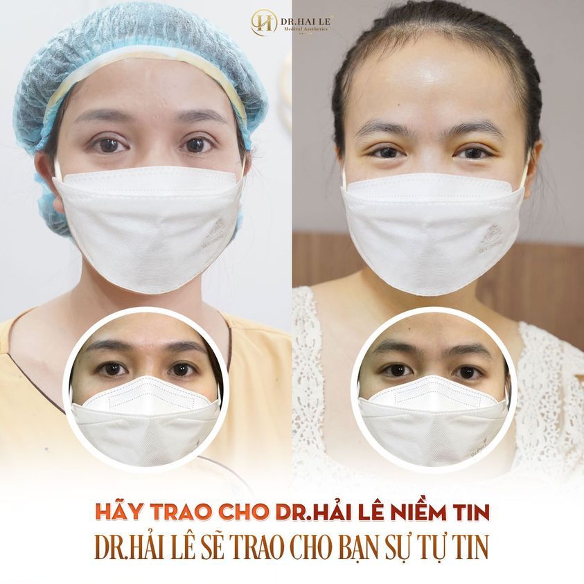 Mí lót "hoá" hai mí Không đau - không sẹo - nếp mí bền đẹp tự nhiên