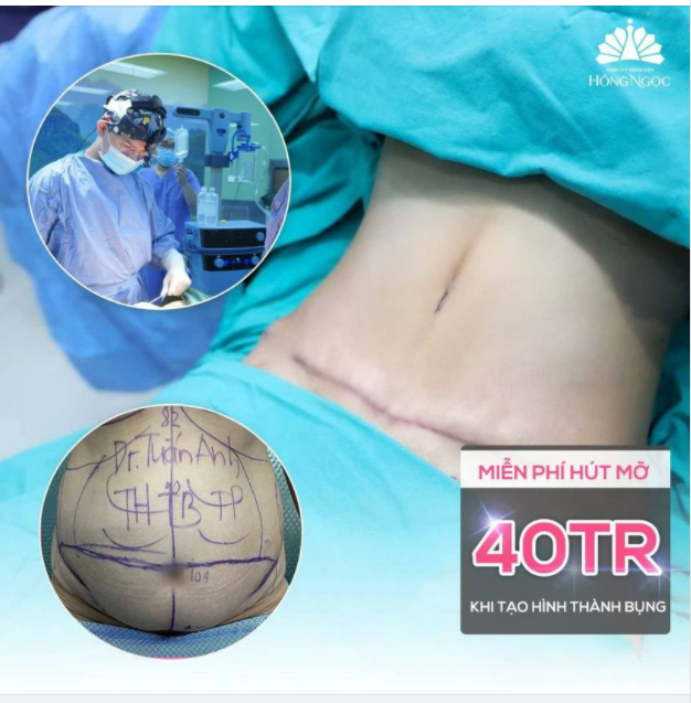 MIỄN PHÍ HÚT MỠ VASER LIPO TRỊ GIÁ 40TR cho khách hàng đăng ký TẠO HÌNH THÀNH BỤNG ngay tại Post này!
