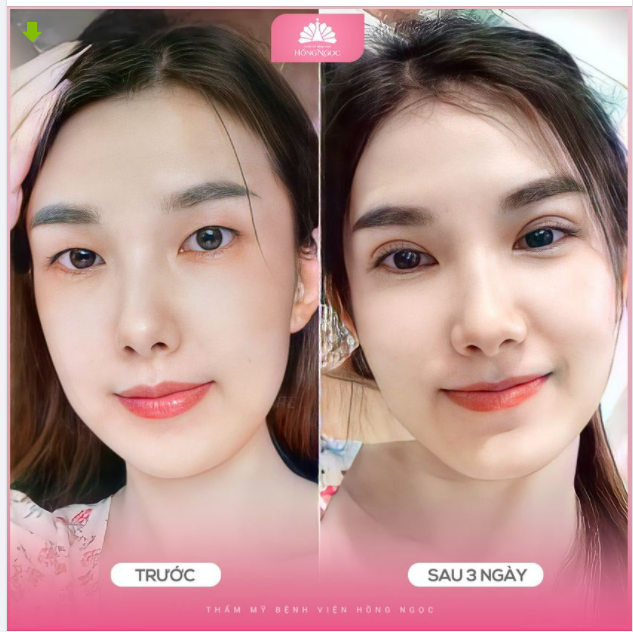 Minh chứng rõ nét nhất chính là màn lột xác ngoạn mục sau 3 ngày cắt mí Eyes Refresh tại Hồng Ngọc của khách hàng Minh Trang dưới đây.
