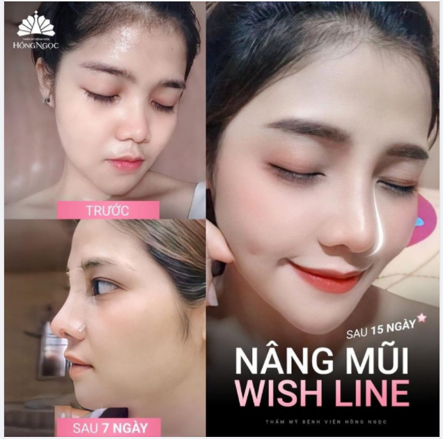 MỘT BƯỚC HÓA NÀNG THƠ NHỜ NÂNG MŨI WISH LINE