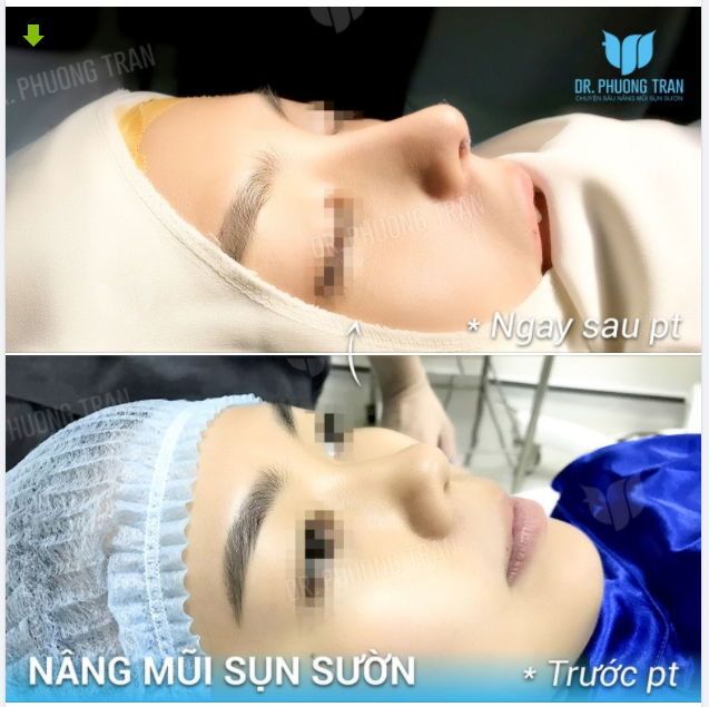 MỘT CA MŨI LẤP ĐẦY MỌI PHIỀN MUỘN