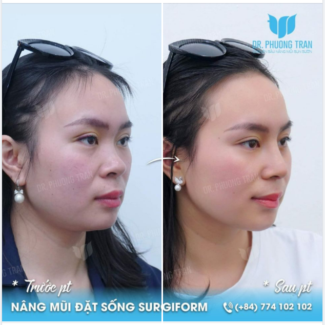 MỘT CHIẾC MŨI ĐẸP, Không cần phải thiệt là cao tây, thiệt là L-line sang chảnh.