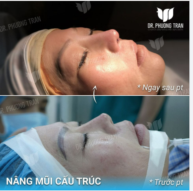 MỘT ĐIỂN HÌNH MŨI CO RÚT, LỆCH SỐNG