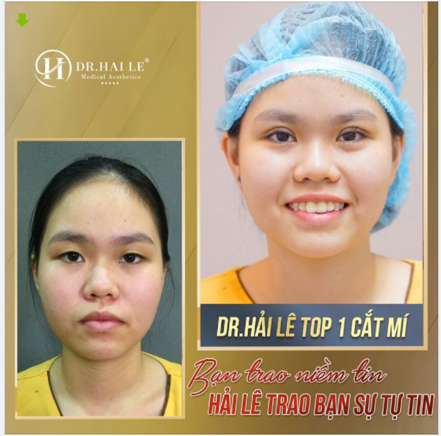 Một vài lời đồn, cắt mỗi mí xong nhìn cũng chả khác mấy, lại kiêng khem các kiểu mệt ơi là mệt.
