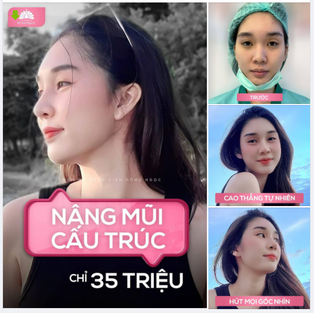 MŨI CAO SANG - THĂNG HẠNG NHAN SẮC CHỈ VỚI 35TRIỆU