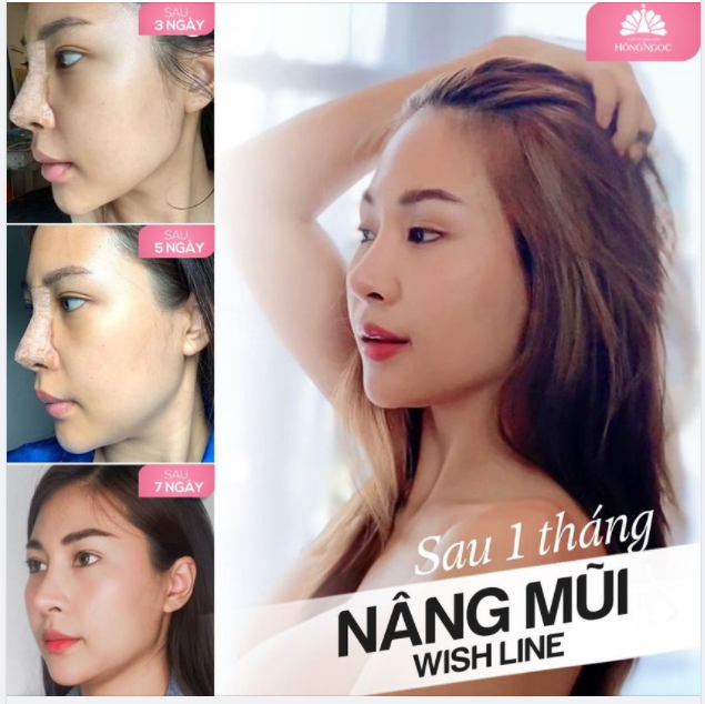 MŨI CAO THANH TÚ - ĐẸP MỌI GÓC NHÌN GIẢM SÂU CHỈ TỪ 25TR