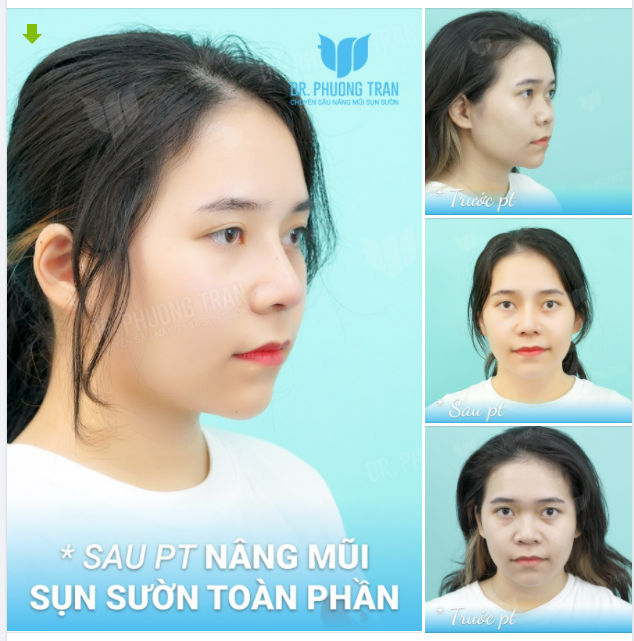 MŨI CAO THON GỌN, “BYE BYE” THẤP BÈ