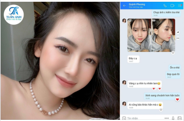 "Mũi em giờ tự nhiên lắm bác sĩ ạ, ai cũng khen, từ ngày làm mũi xong em chỉ thích chụp ảnh tự sướng để đăng lên FB khoe thôi, nhất là chụp ở góc ngiêng "