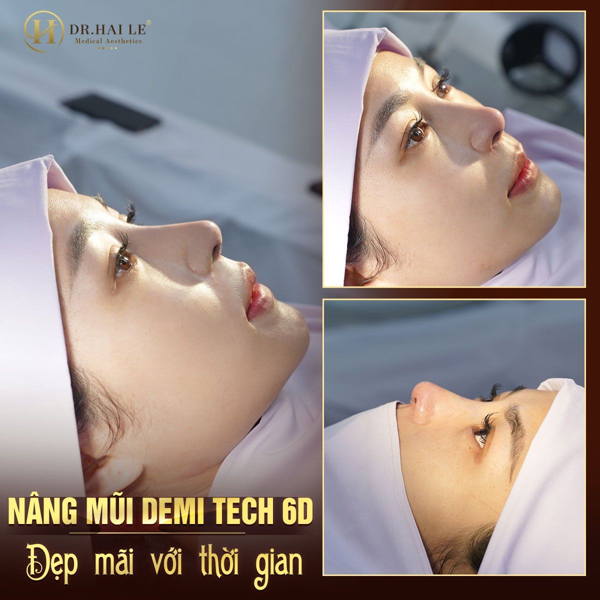 Mũi thấp tẹt ư! nâng mũi thẩm mỹ thôi