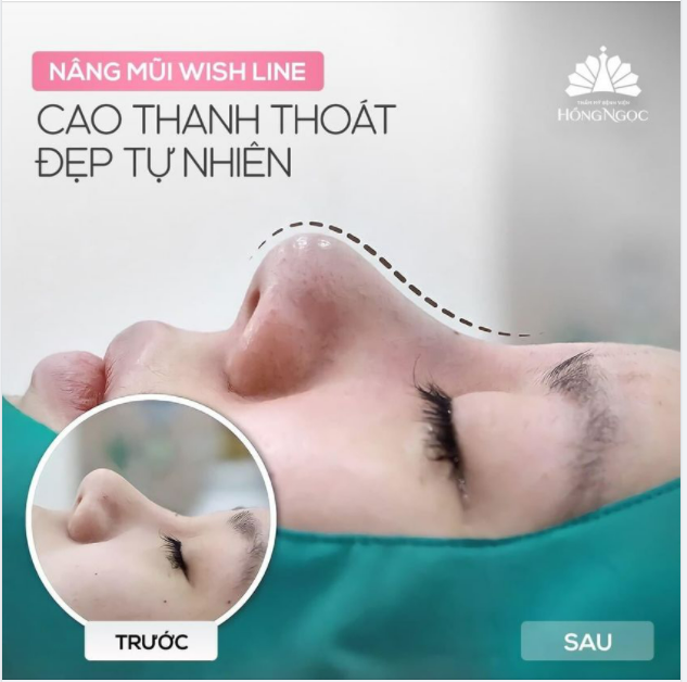MỪNG NGÀY TRỞ LẠI - NÂNG MŨI CẤU TRÚC WISH LINE CHỈ CÒN 35TR