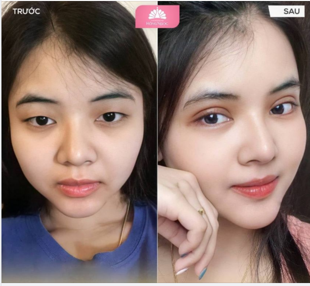 MUỐN BIẾT SAU CẮT MÍ MẮT SẼ ĐẸP THẾ NÀO?