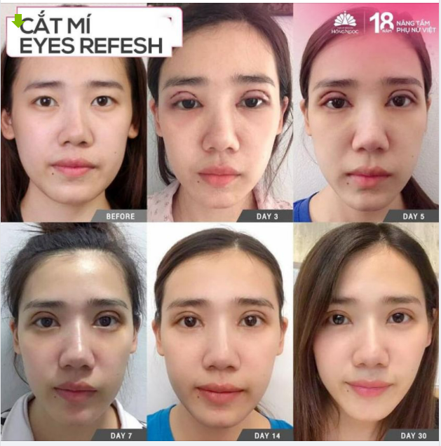 MUỐN CÓ MẮT TRẺ TRUNG KHÔNG KHÓ -ĐẾN NGAY VỚI HỒNG NGỌC