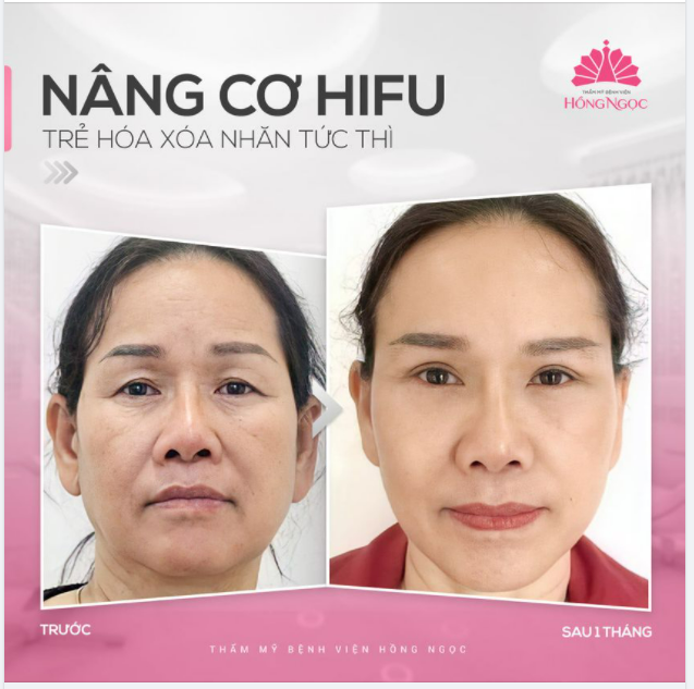 NÂNG CƠ HIFU - LÀM 1 BUỔI TRẺ RA CHỤC TUỔI