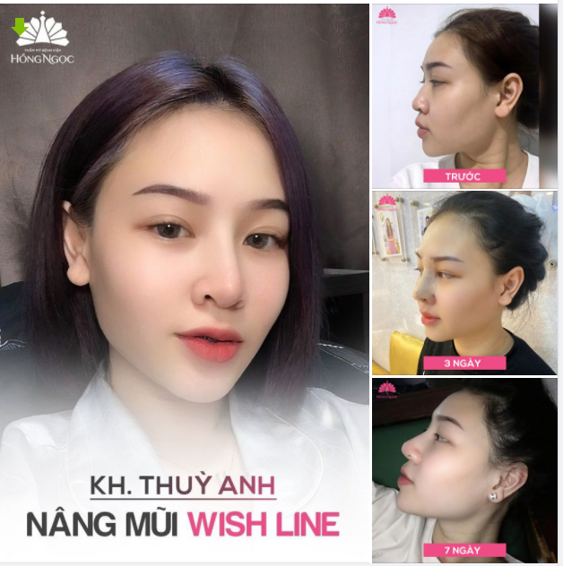 Nâng mũi 3 ngày ổn định - 7 ngày đẹp tự nhiên ở Hồng Ngọc là có thật!