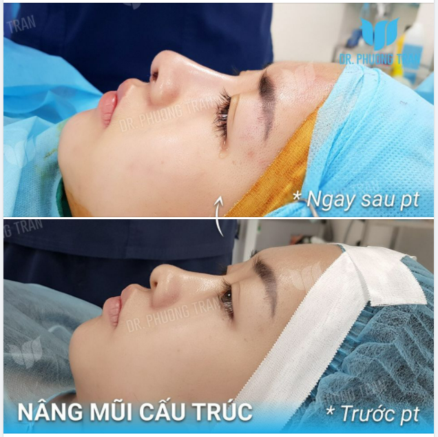 Nâng mũi cấu trúc Hạnh phúc hết mũi gồ