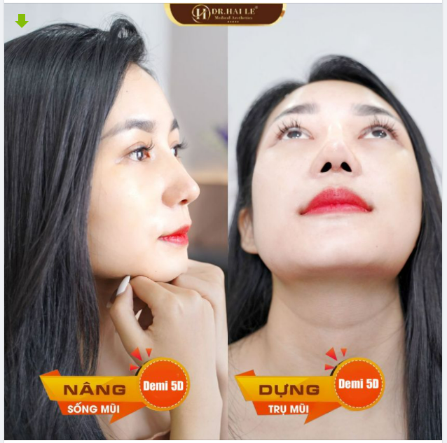 NÂNG MŨI CÓ PHÁ TƯỚNG KHÔNG VÀ GÓC NHÌN TRONG NHÂN TƯỚNG HỌC ?