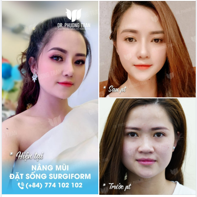 NÂNG MŨI ĐẶT SỐNG SURGIFORM: GIẢI PHÁP TỐI ƯU NHẤT CHO NHỮNG BẠN CHỈ MUỐN CAN THIỆP PHẦN SỐNG MŨI