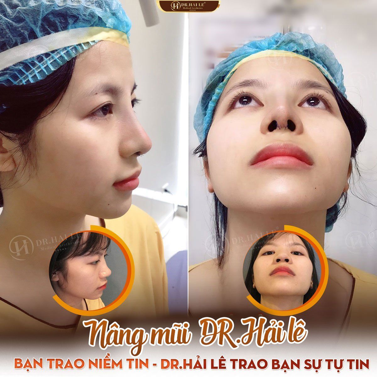 NÂNG MŨI DEMI 5D - DR.HẢI LÊ LÀM LÀ ĐẸP