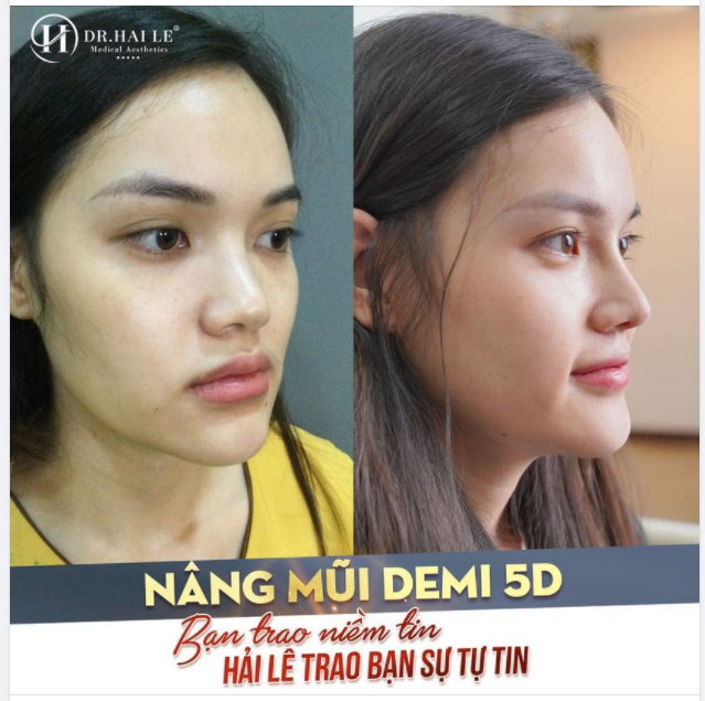 NÂNG MŨI DEMI 5D - DR.HẢI LÊ LÀM LÀ ĐẸP