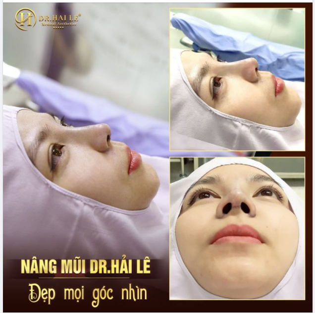 Nâng mũi Demi Tech 6D - Mũi đẹp vững bền không phá vỡ cấu trúc mũi gốc!