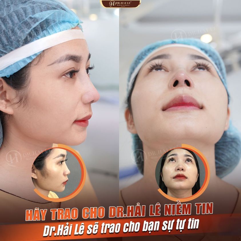 Nâng mũi Dr.Hải Lê chưa bao giờ hết HOT